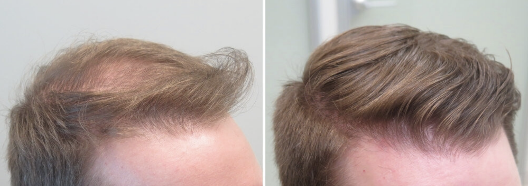 Before / After 5